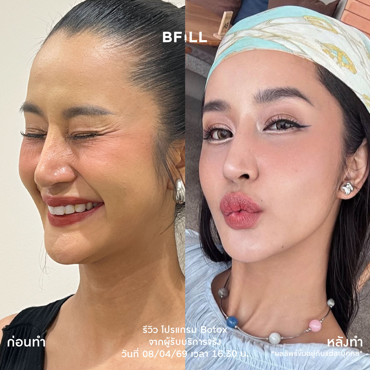 Program Botox Nabota