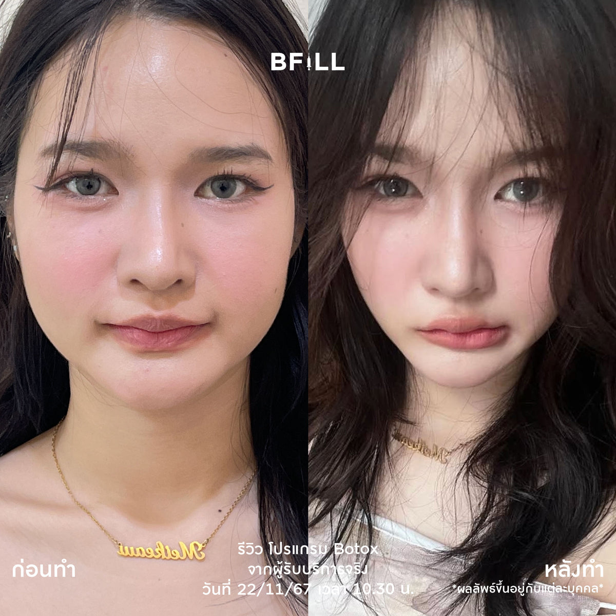 Program Botox Nabota