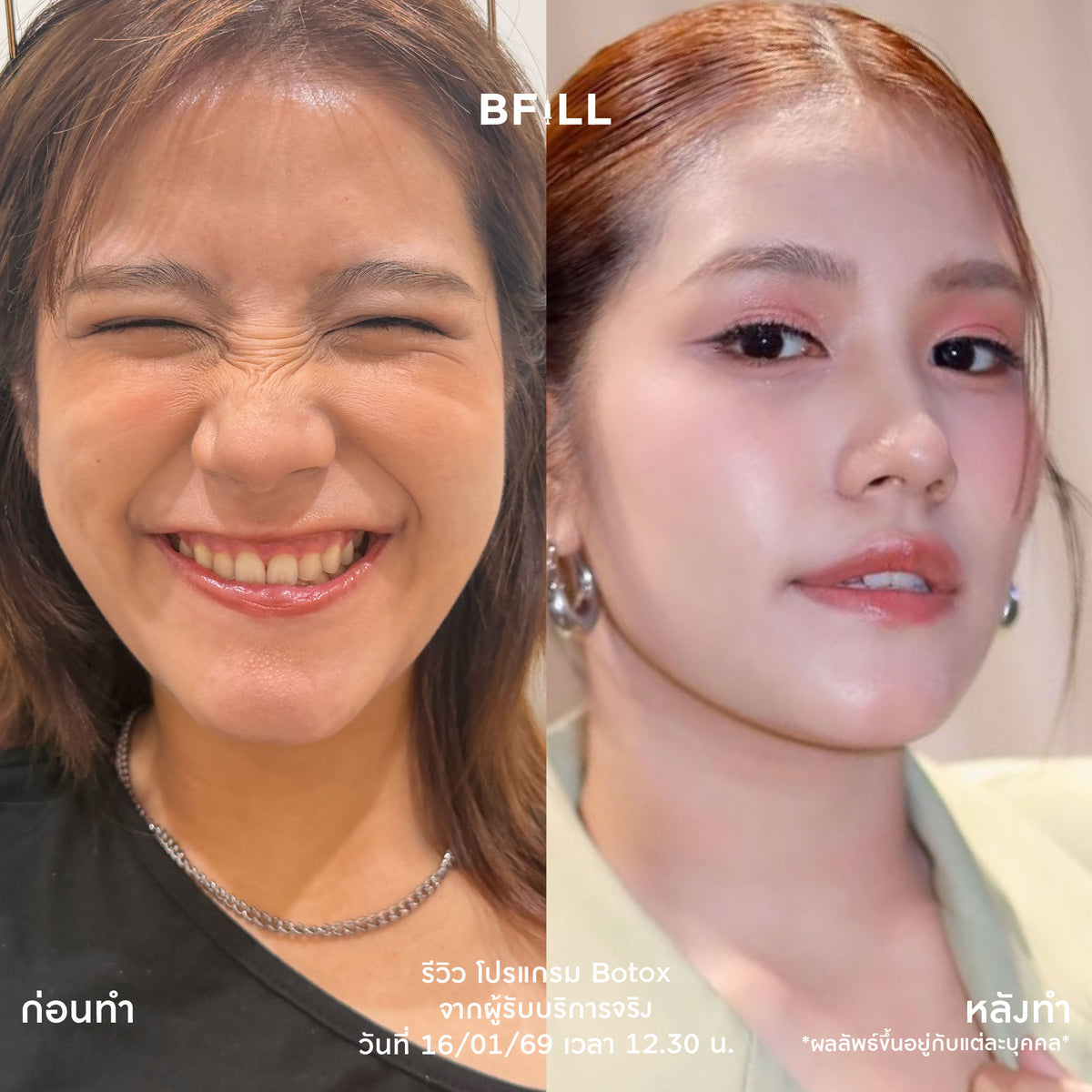 Program Botox Nabota