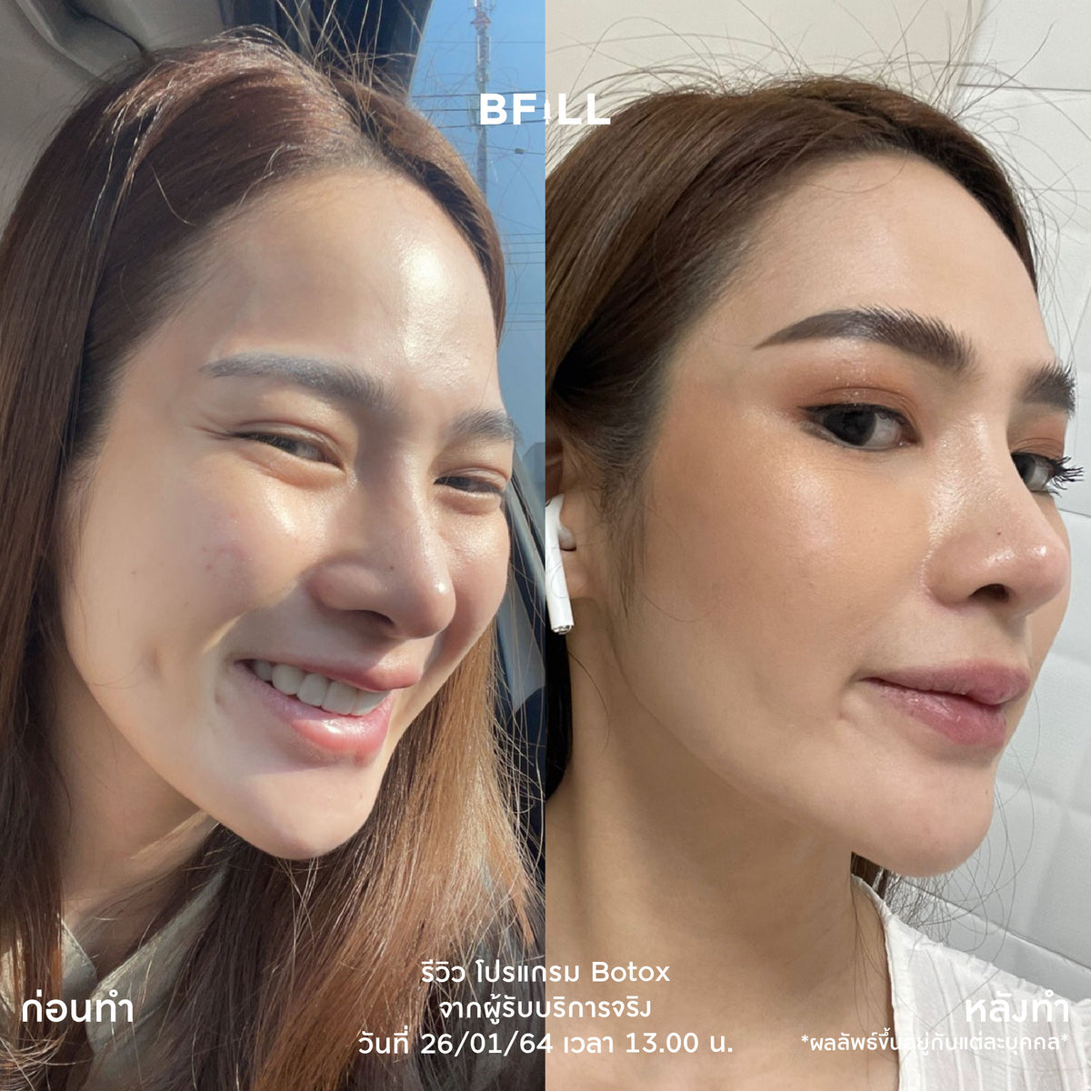 Program Botox Nabota