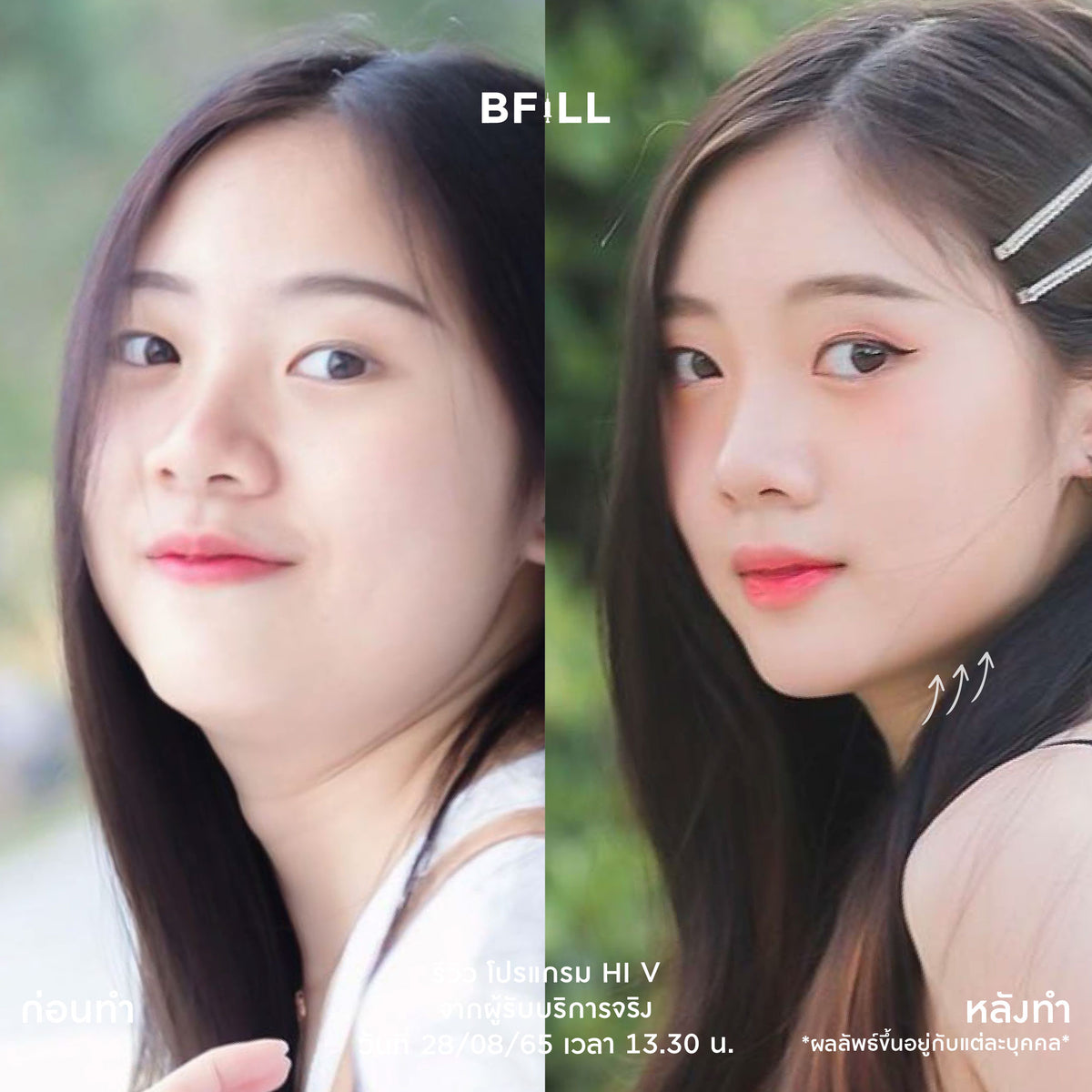 Program Hi V (Hifu) By Doctor ไฮวี (ทำโดยแพทย์)