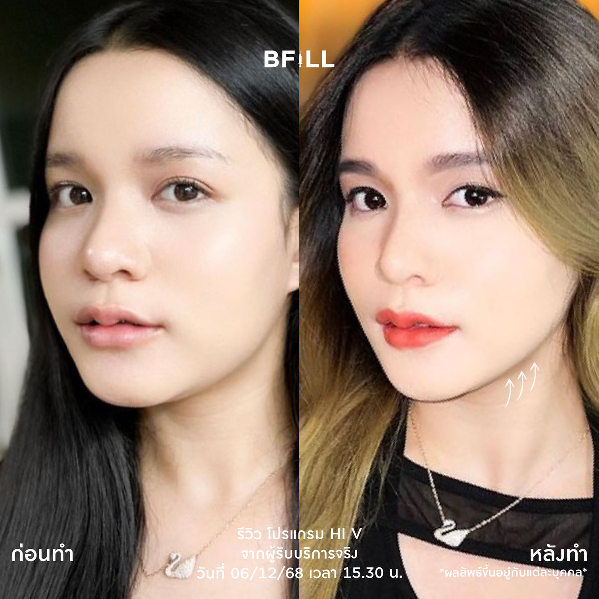 Program Hi V (Hifu) By Doctor ไฮวี (ทำโดยแพทย์)