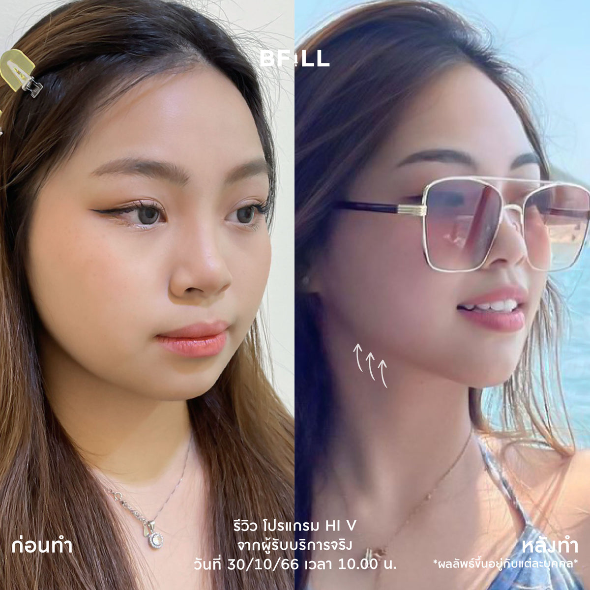 Program Hi V (Hifu) By Doctor ไฮวี (ทำโดยแพทย์)