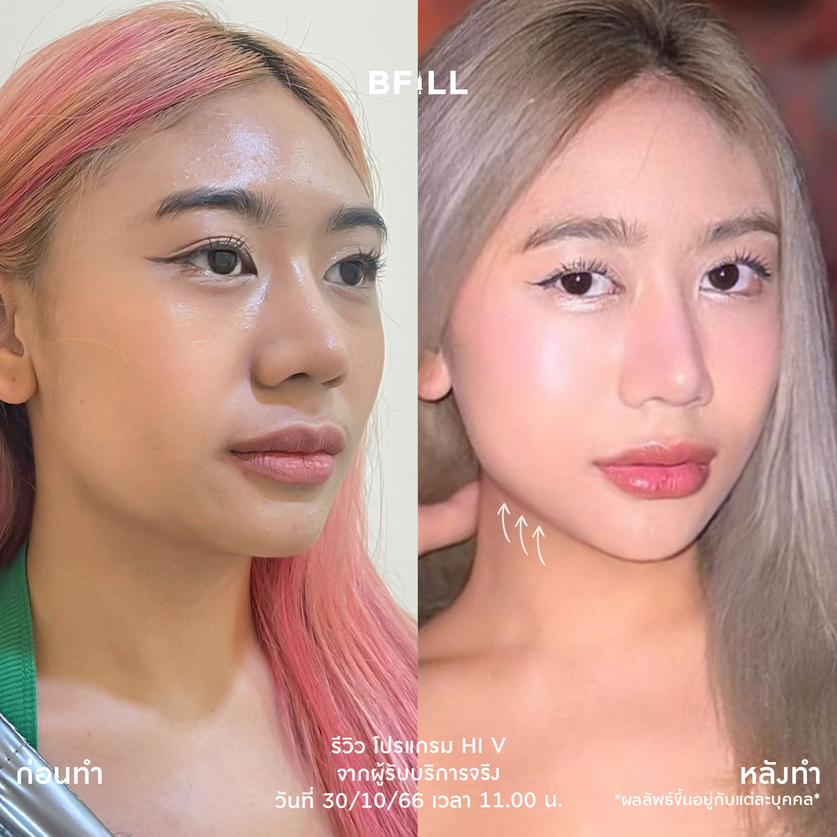 Program Hi V (Hifu) By Doctor ไฮวี (ทำโดยแพทย์)