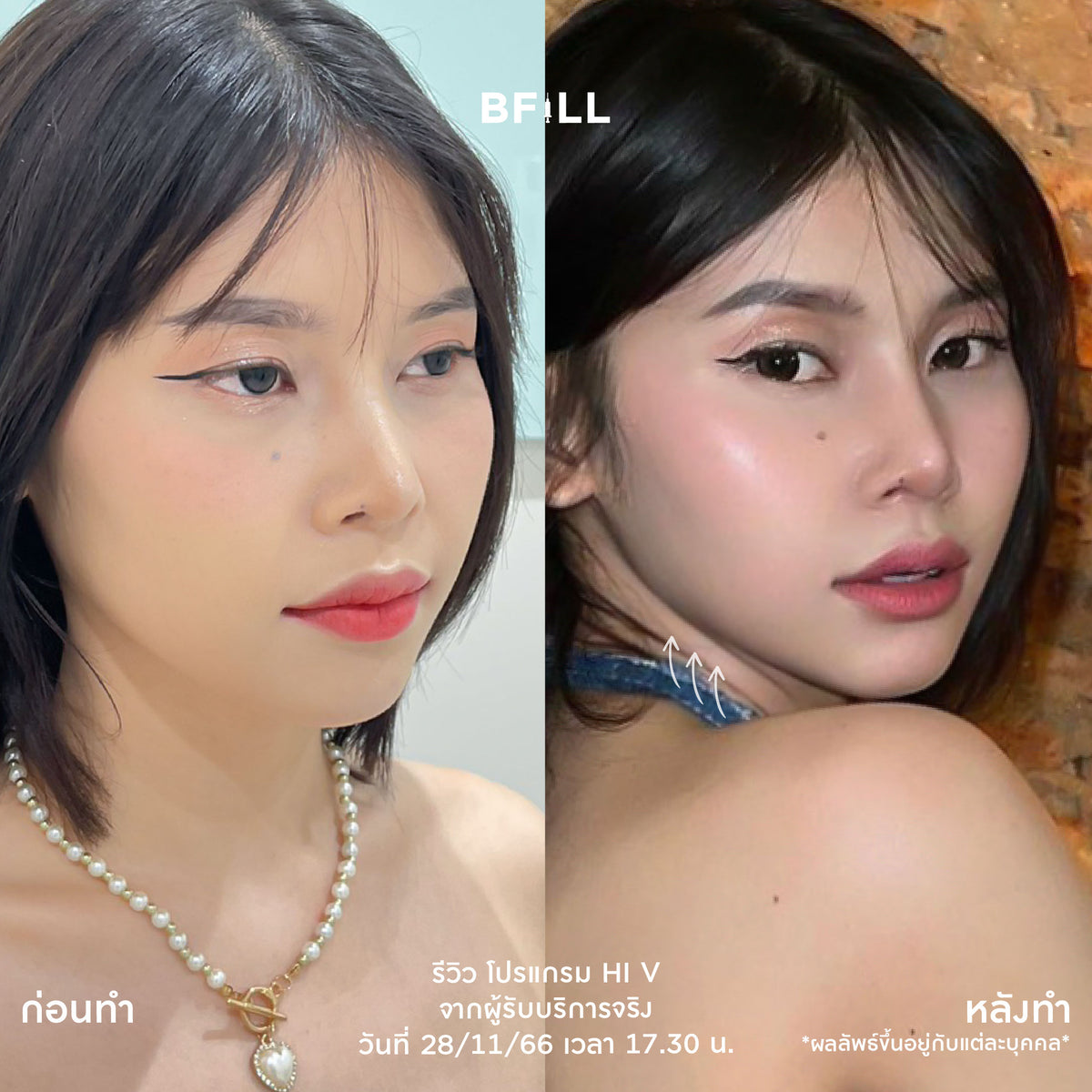 Program Hi V (Hifu) By Doctor ไฮวี (ทำโดยแพทย์)