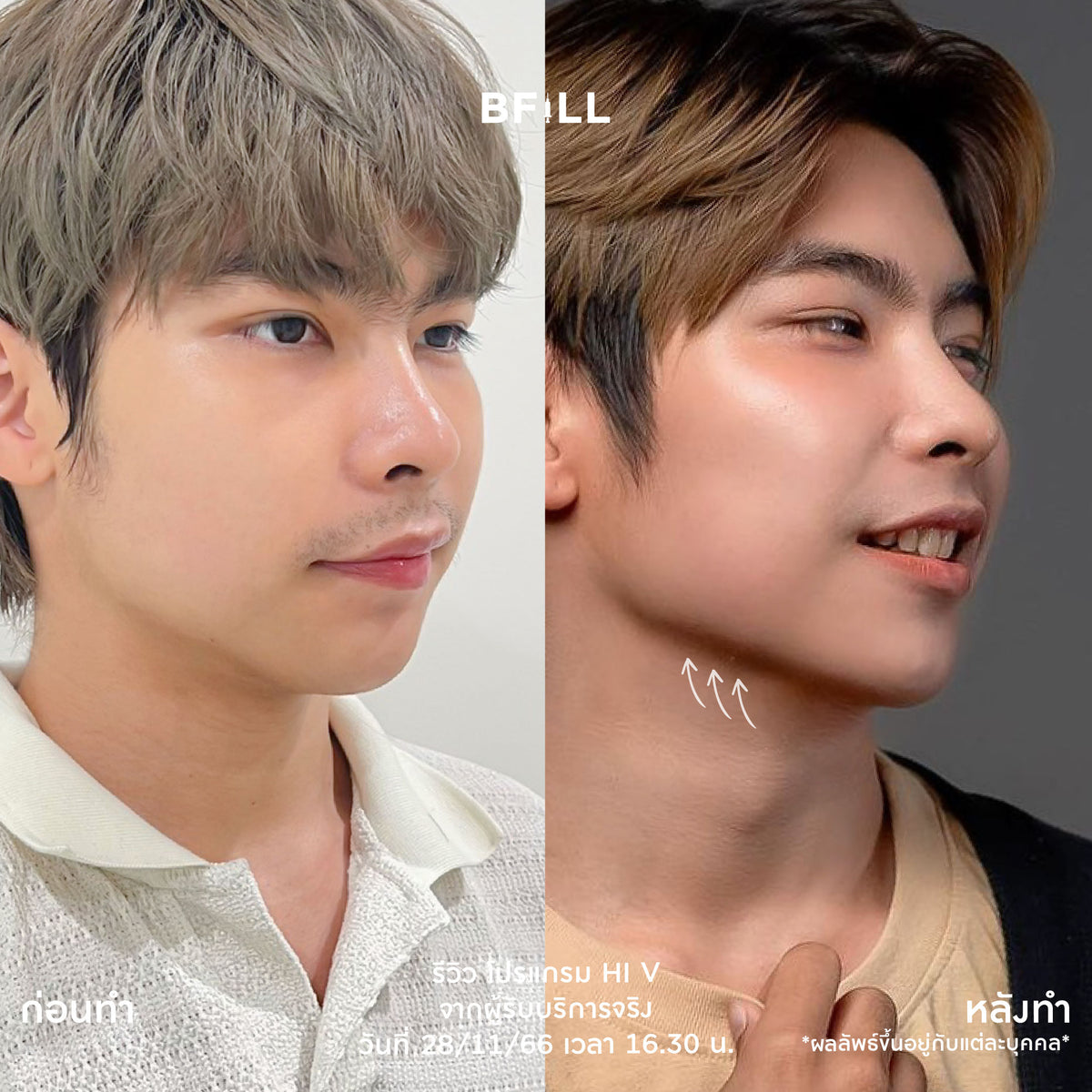 Program Hi V (Hifu) By Doctor ไฮวี (ทำโดยแพทย์)