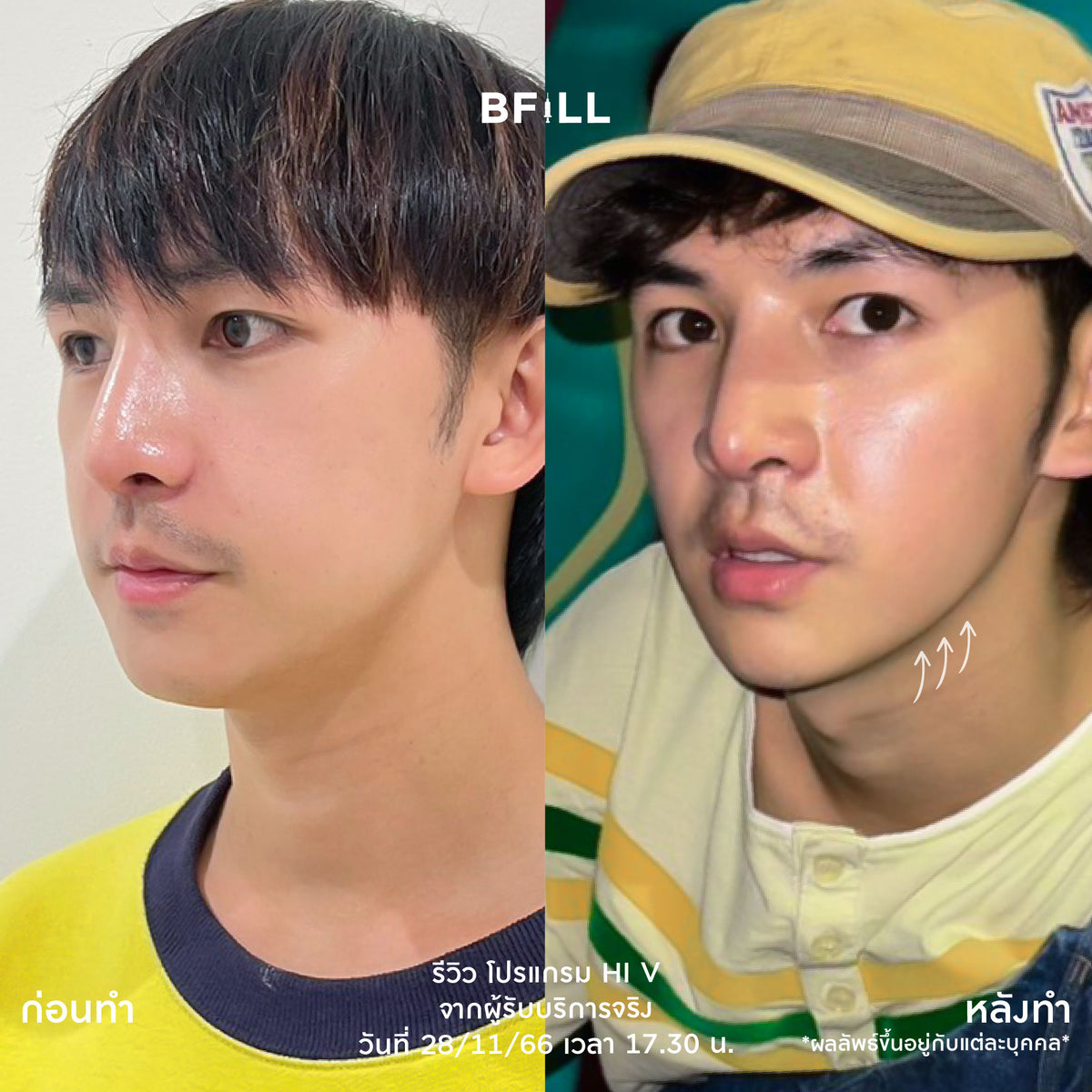 Program Hi V (Hifu) By Doctor ไฮวี (ทำโดยแพทย์)