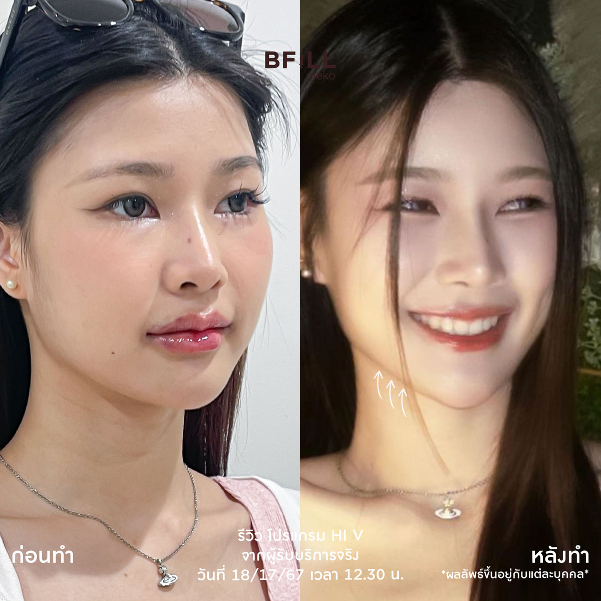 Program Hi V (Hifu) By Doctor ไฮวี (ทำโดยแพทย์)