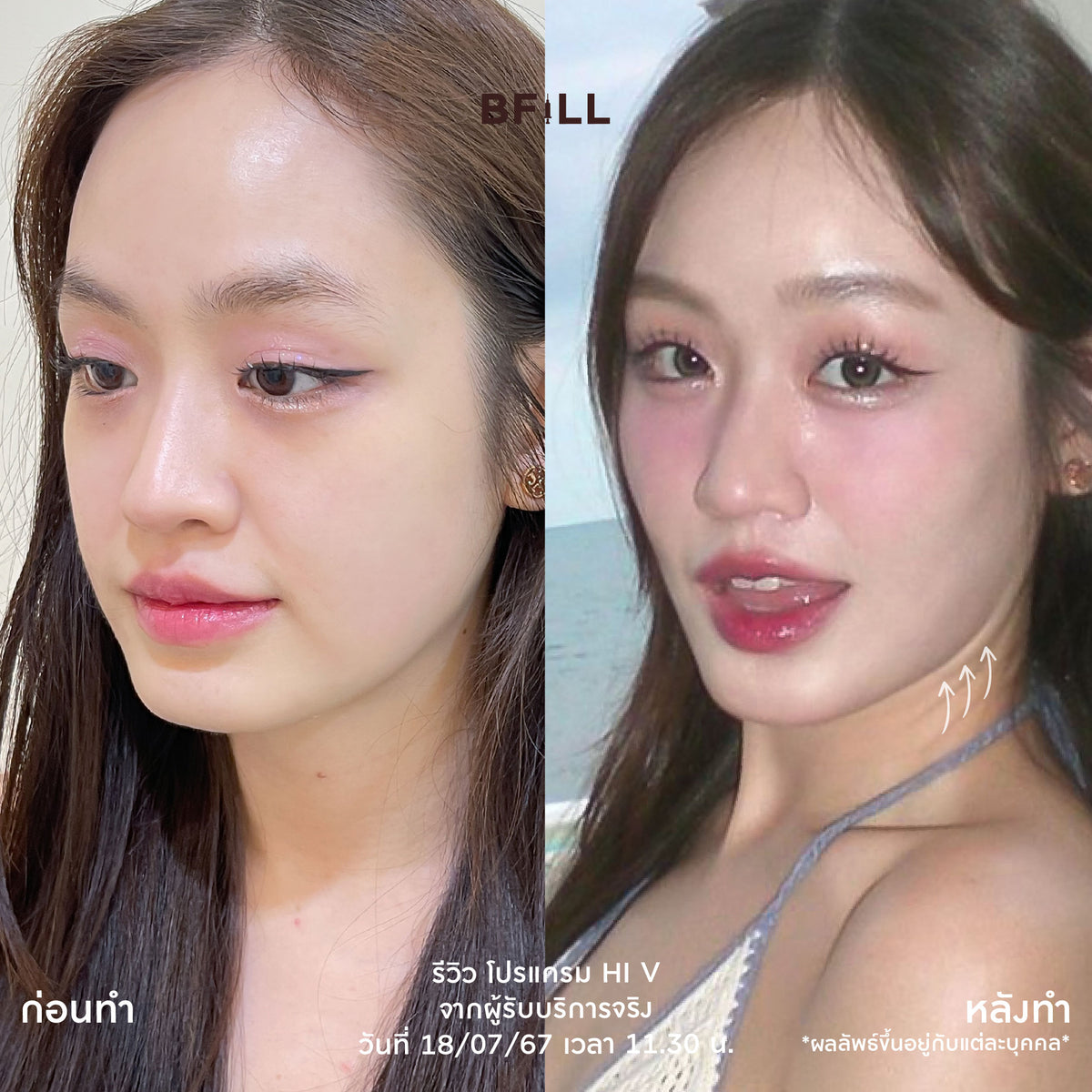 Program Hi V (Hifu) By Doctor ไฮวี (ทำโดยแพทย์)