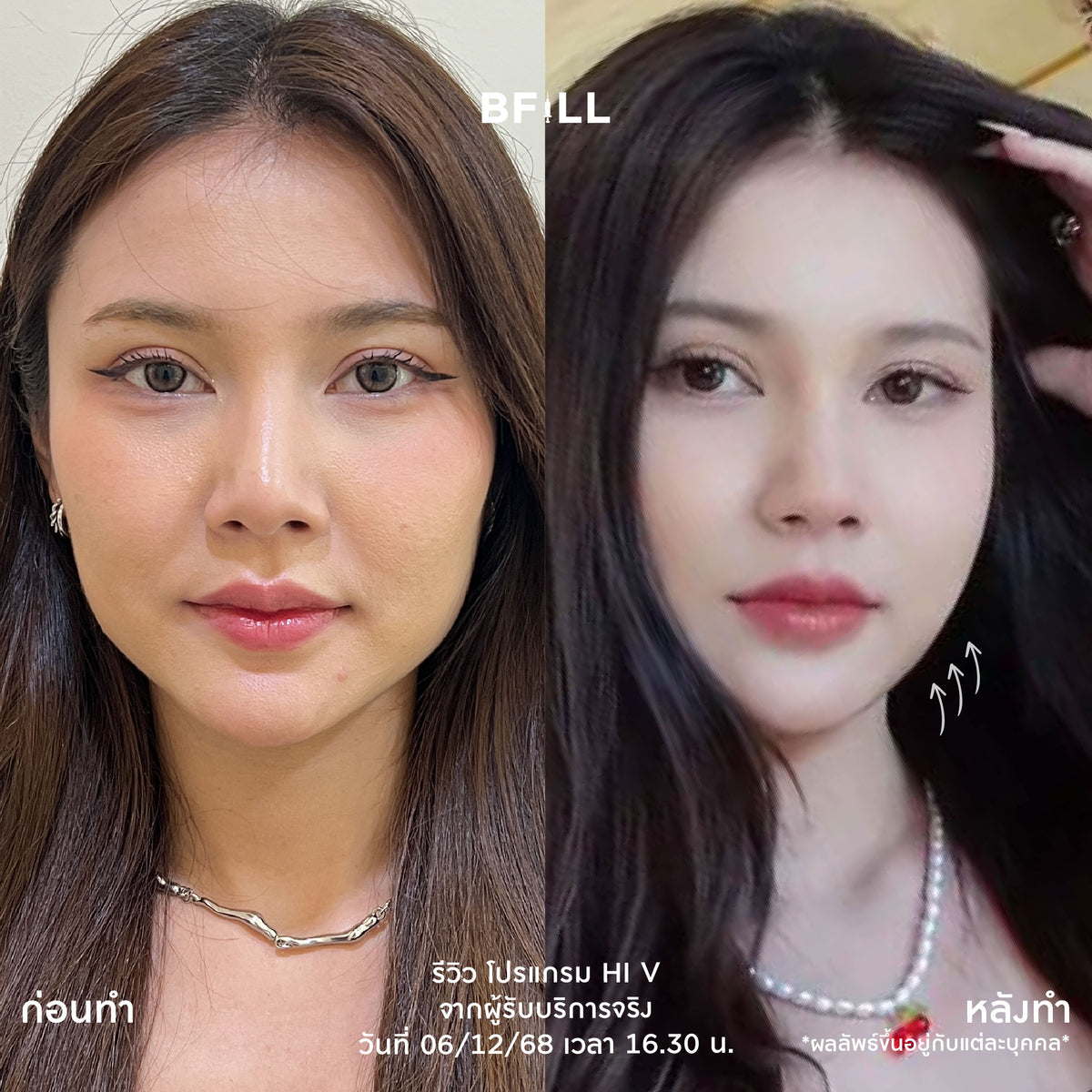 Program Hi V (Hifu) By Doctor ไฮวี (ทำโดยแพทย์)