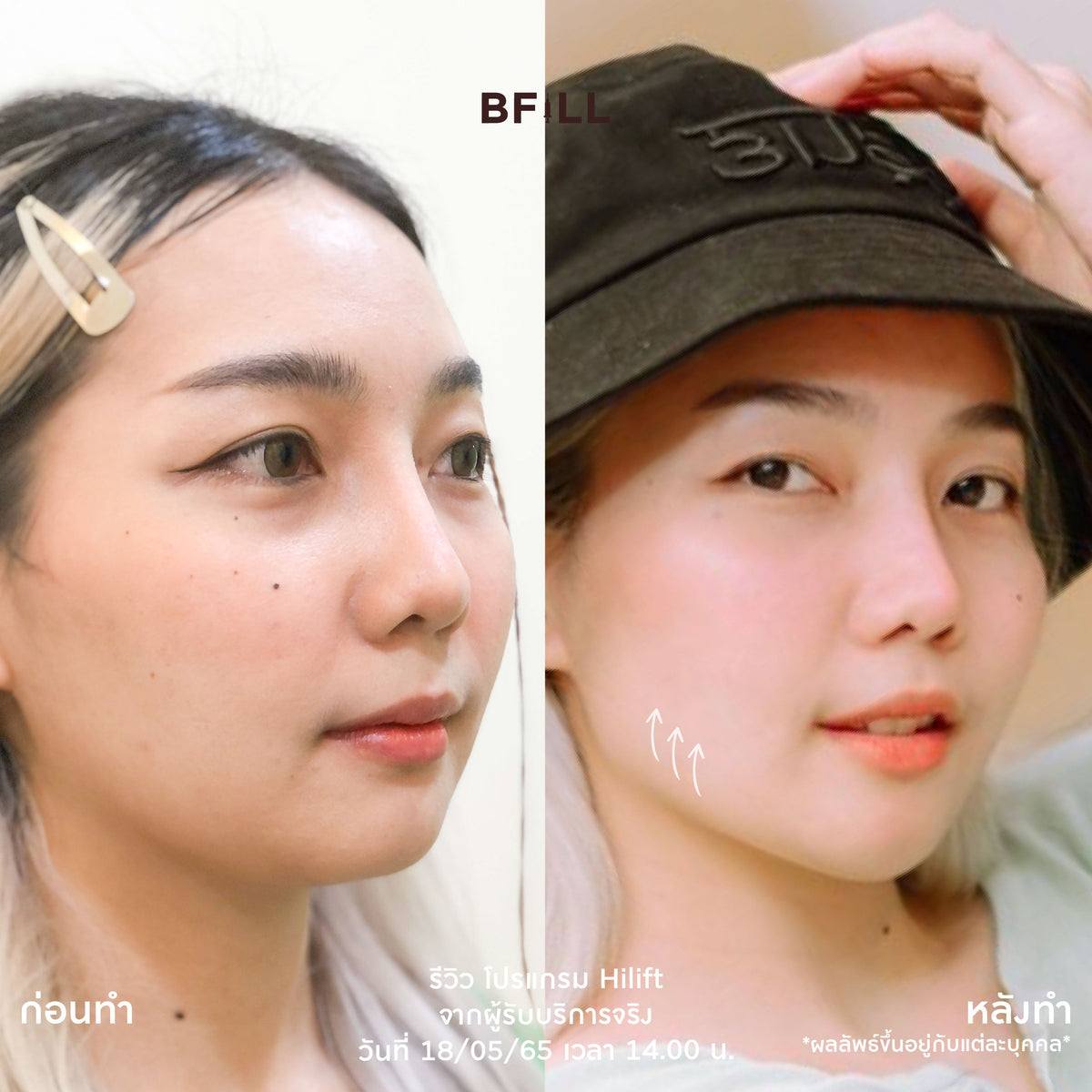 专业人士操作的 Hi Lift MPT 项目，仅限阿索克分店