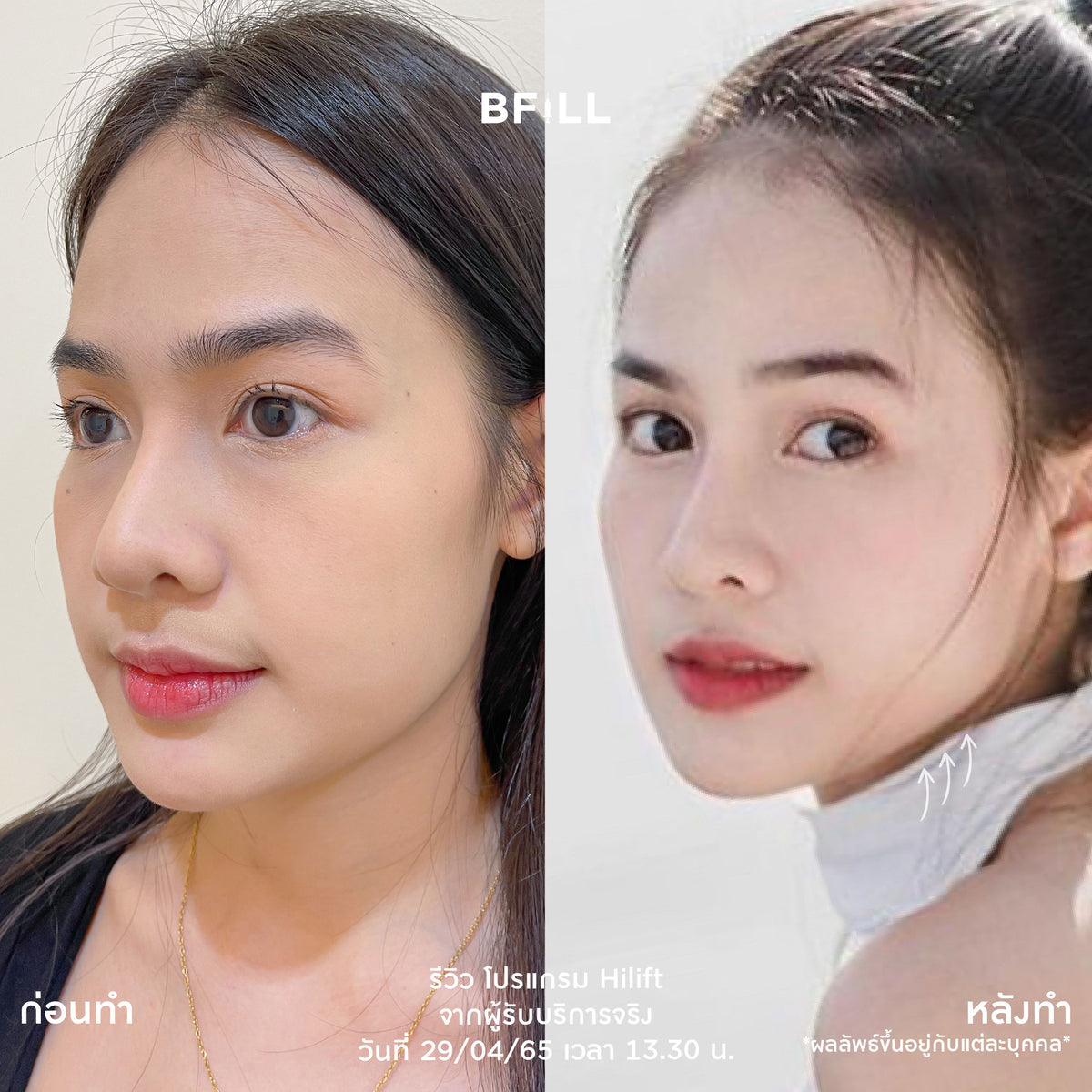 专业人士操作的 Hi Lift MPT 项目，仅限阿索克分店