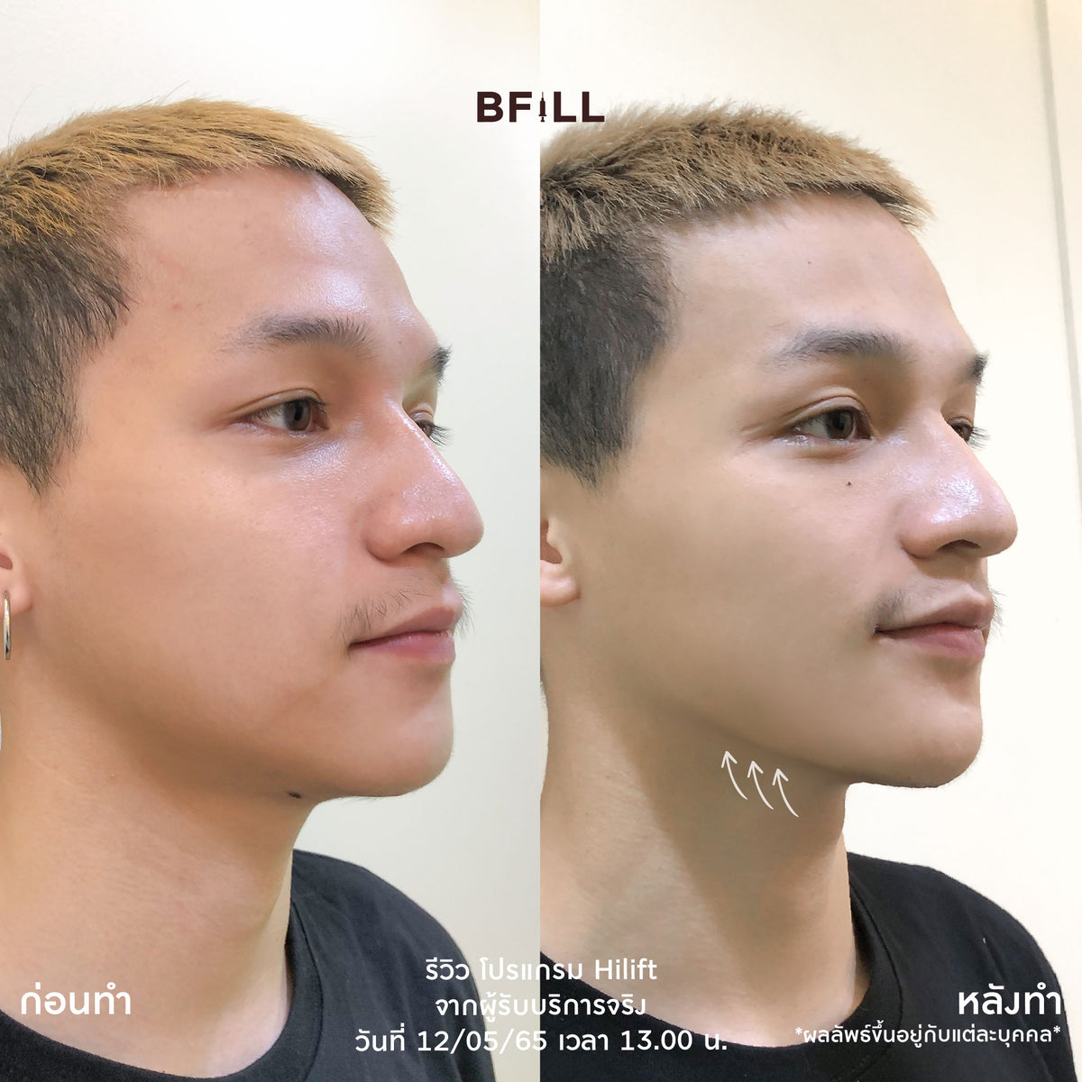 专业人士操作的 Hi Lift MPT 项目，仅限阿索克分店