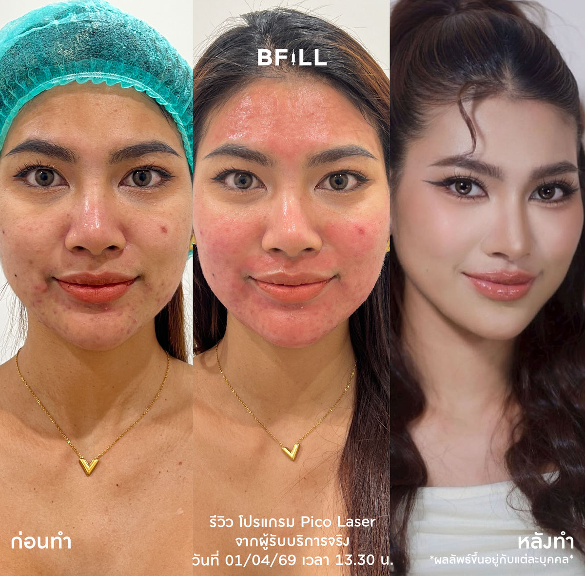 Program Pico Laser Facial: Full-face freckle and dark spot reduction or full-face acne scar treatment by Specialist, only at the Asok branch