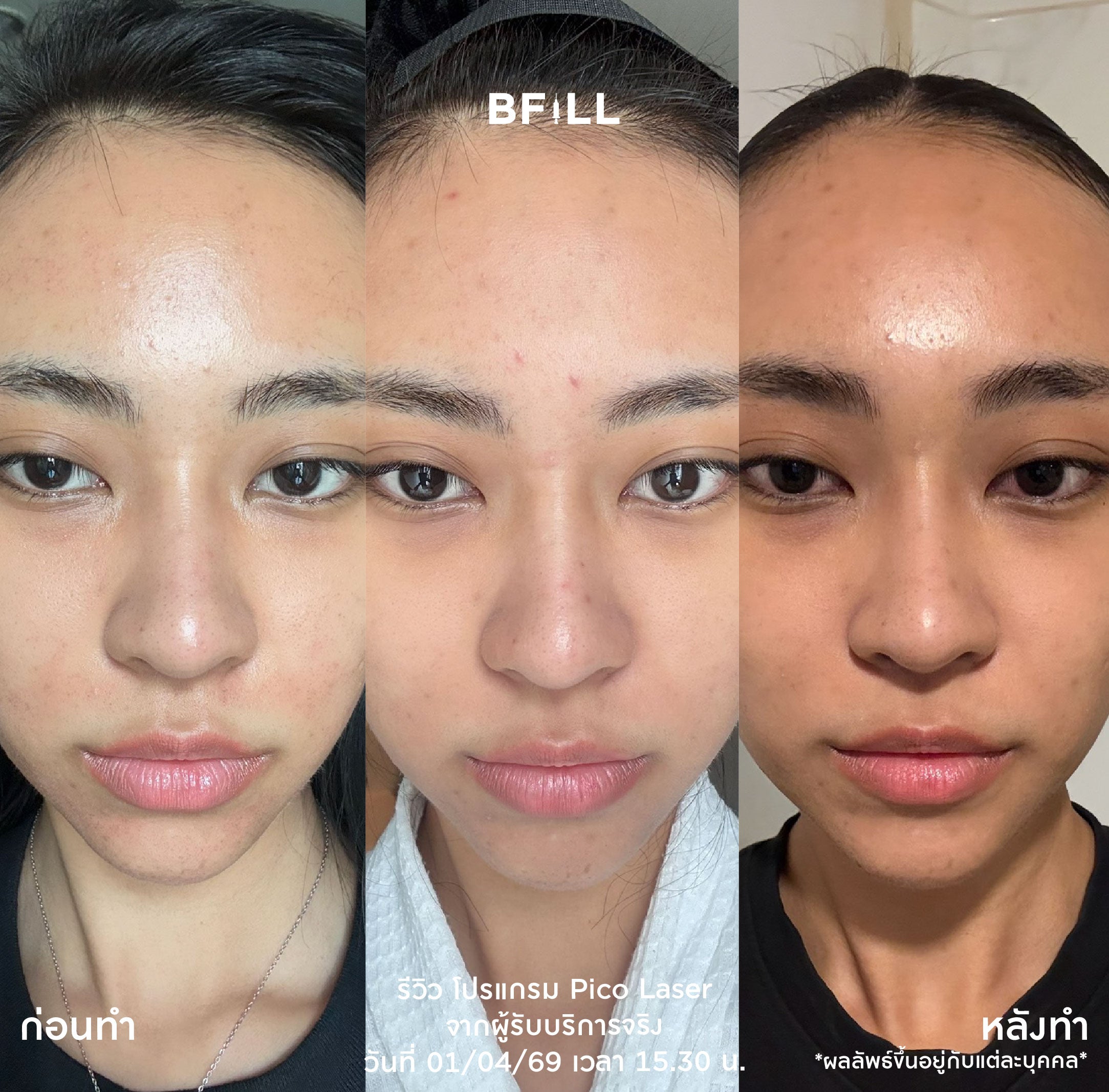 Pico Laser Facial – BFill Clinic