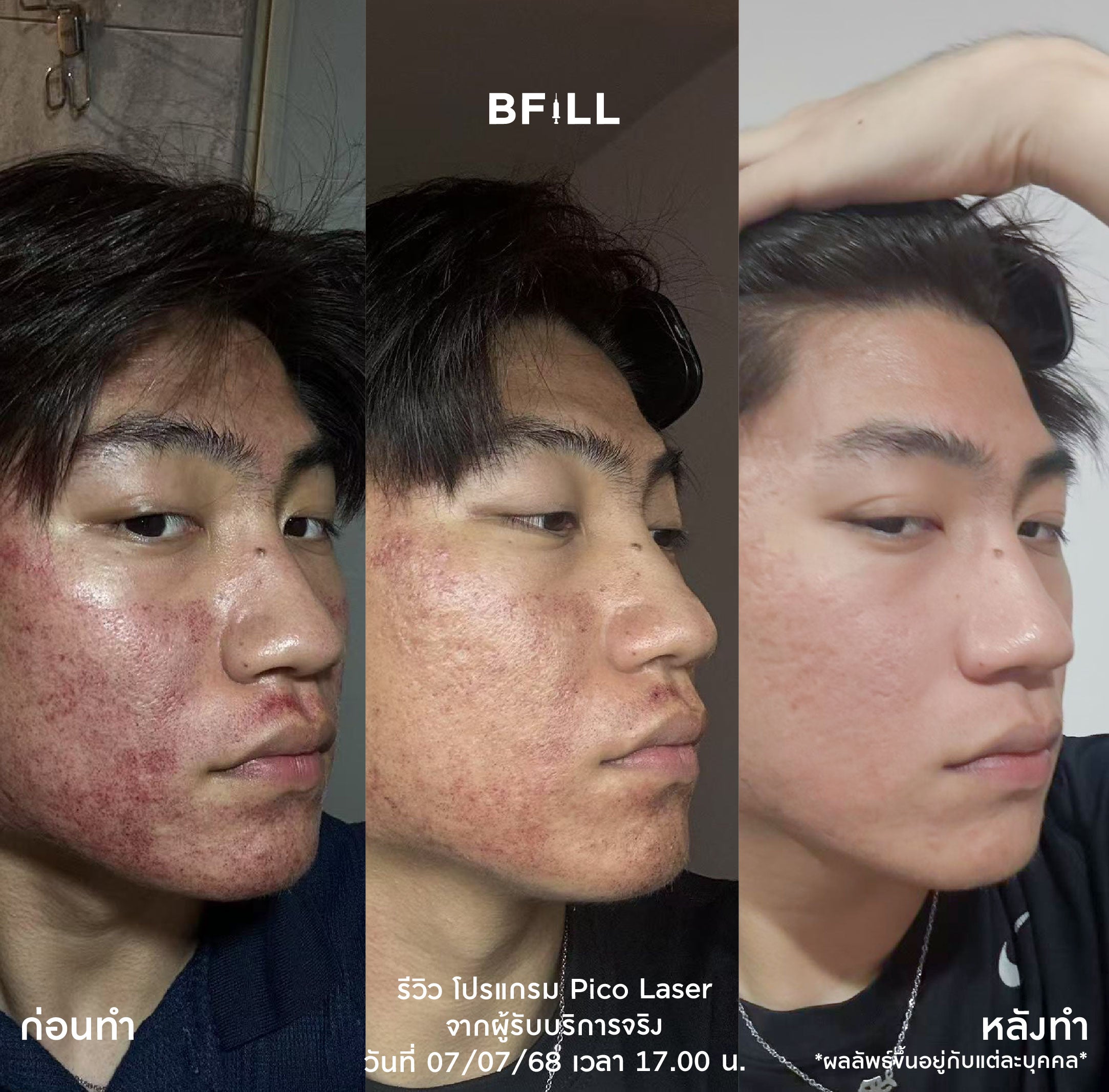 Pico Laser Facial – BFill Clinic