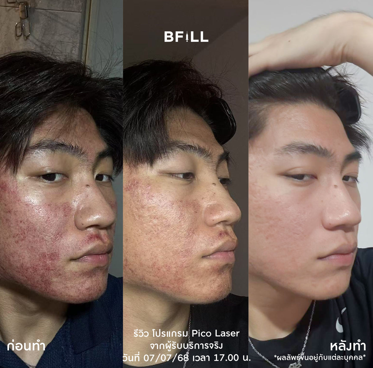 Program Pico Laser Facial: Full-face freckle and dark spot reduction or full-face acne scar treatment by Specialist, only at the Asok branch