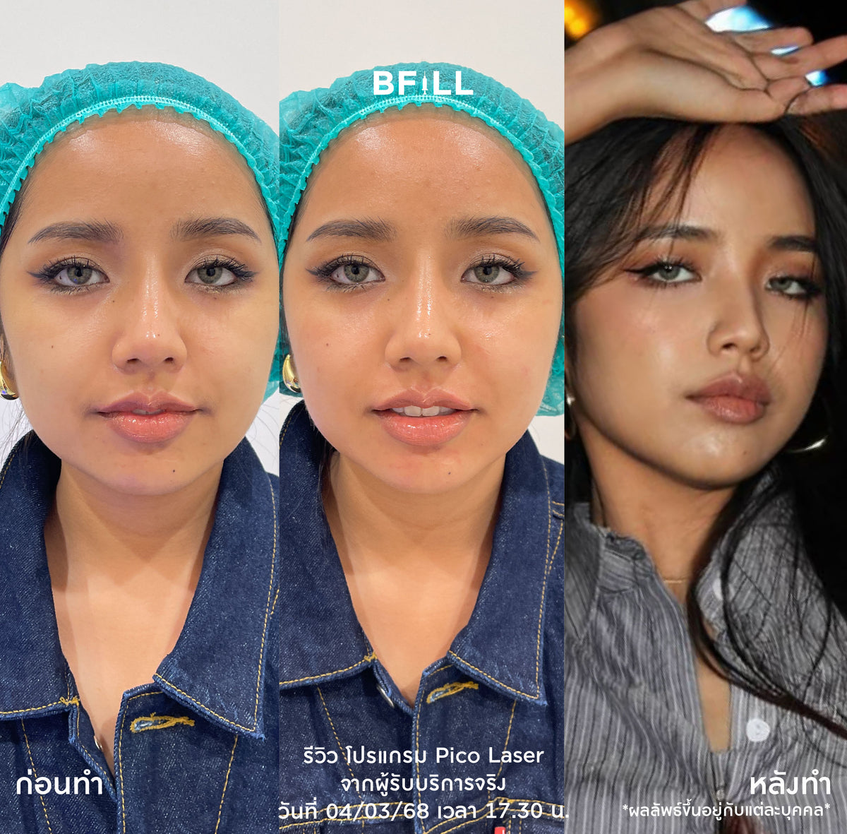 Program Pico Laser Facial: Full-face freckle and dark spot reduction or full-face acne scar treatment by Specialist, only at the Asok branch