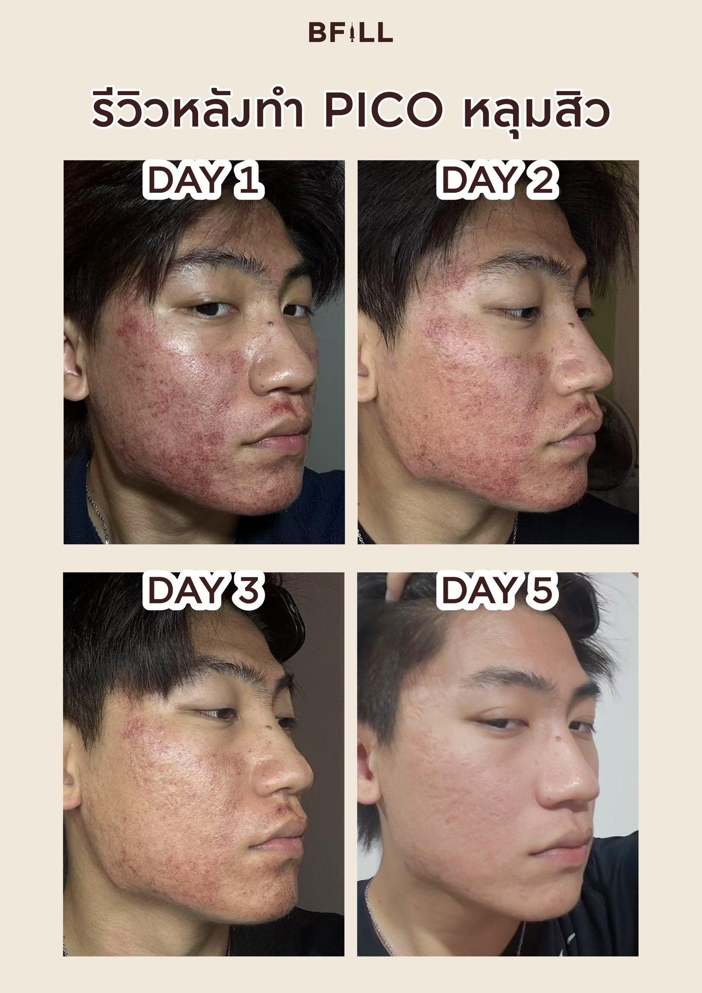 Pico Laser Facial ลดกระจุดด่างดำทั่วหน้า หรือ ฟื้นฟูหลุมสิวทั่วหน้า by Specialist Only Asok