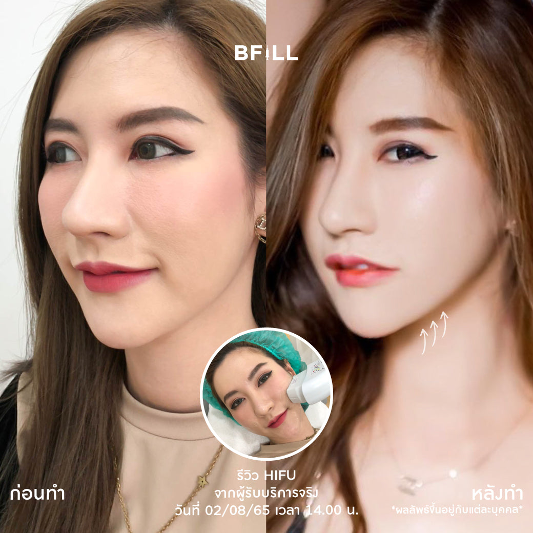 专家级高端Hifu（由专家操作）