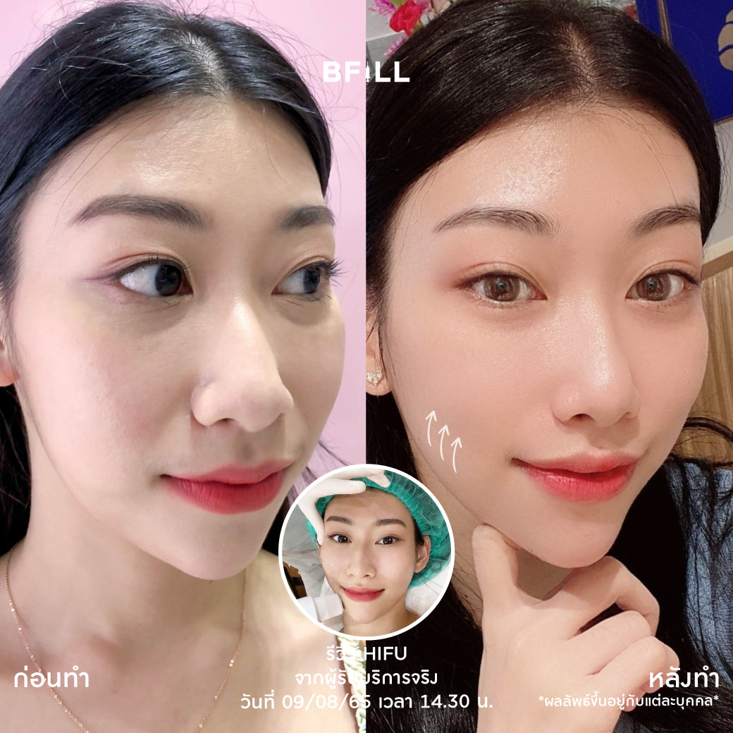 专家级高端Hifu（由专家操作）