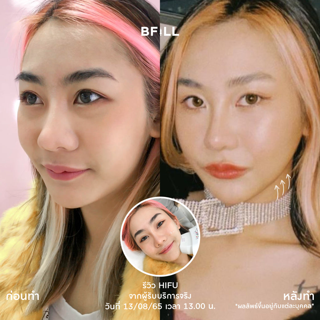 专家级高端Hifu（由专家操作）