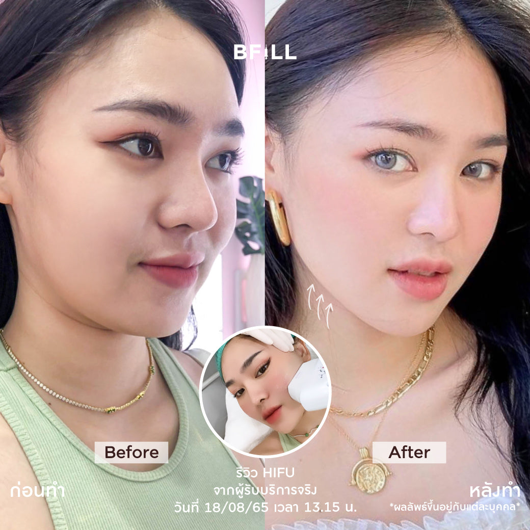 专家级高端Hifu（由专家操作）