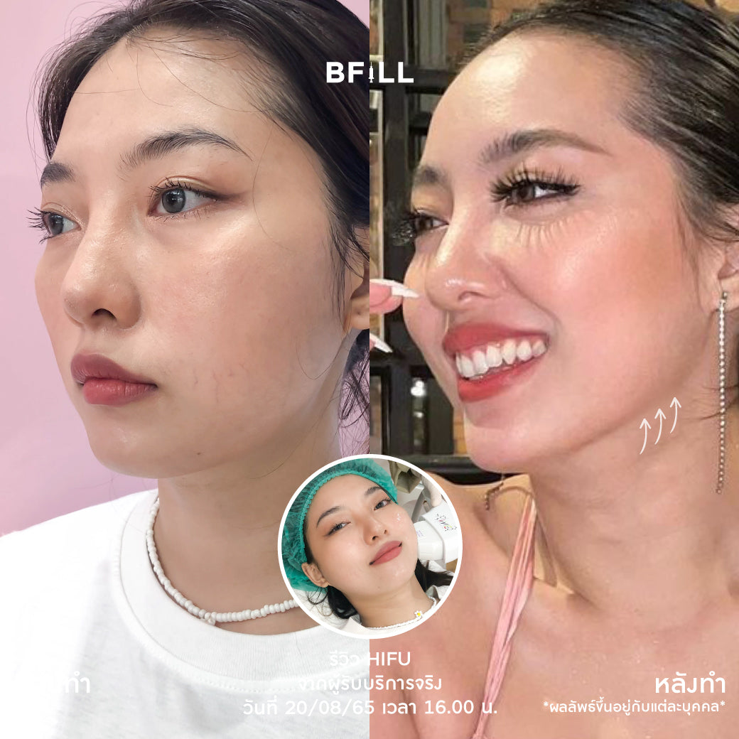 专家级高端Hifu（由专家操作）