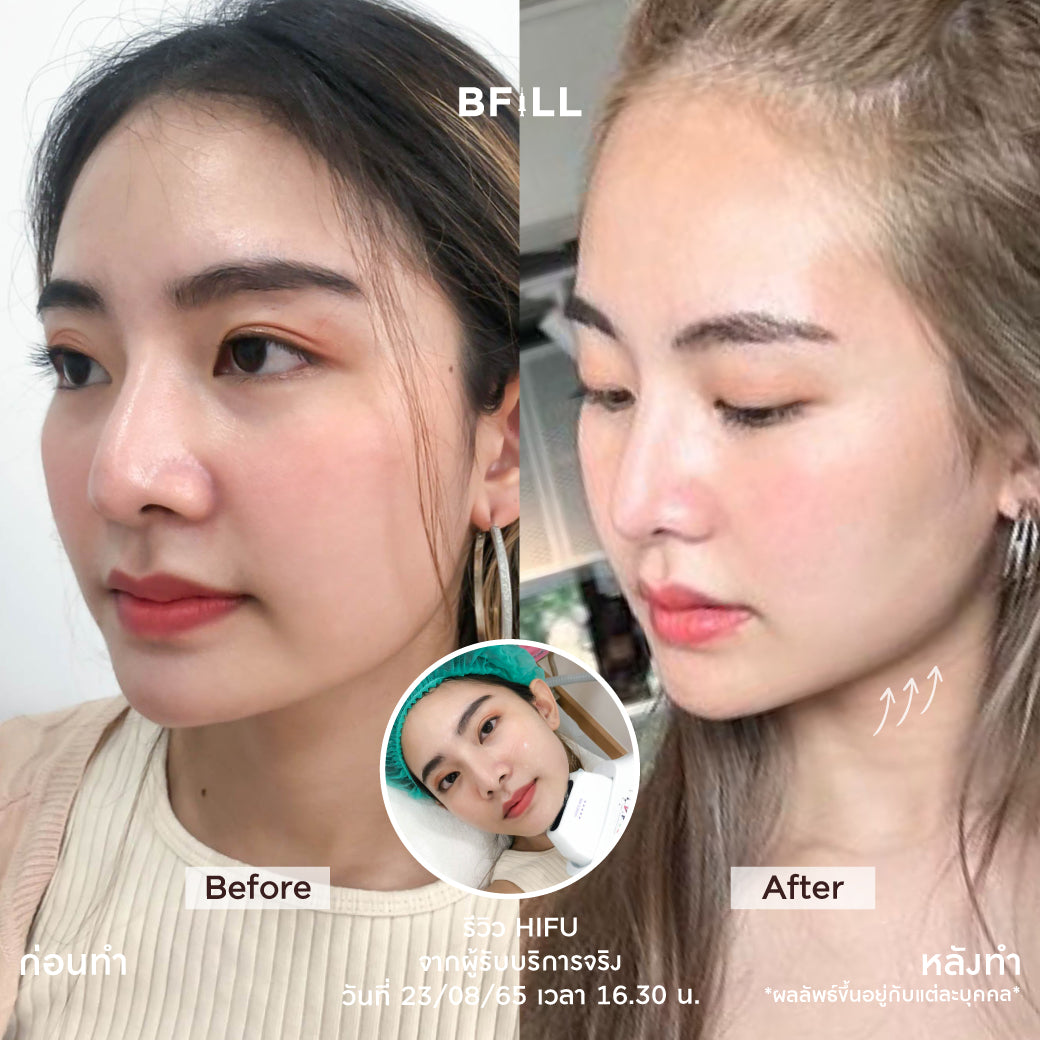 专家级高端Hifu（由专家操作）