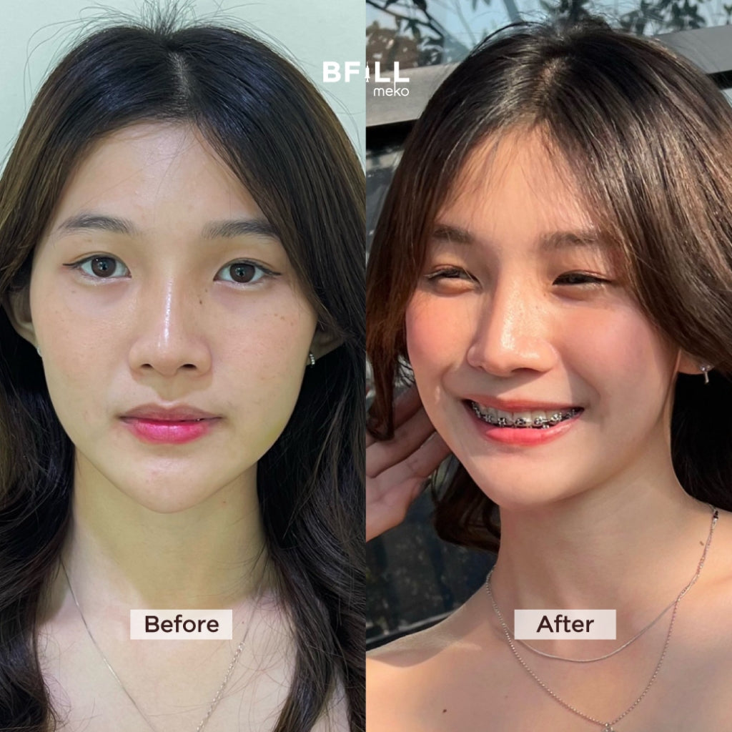 Juvelook 皮肤增强剂 不含麻醉（麻醉加200泰铢）