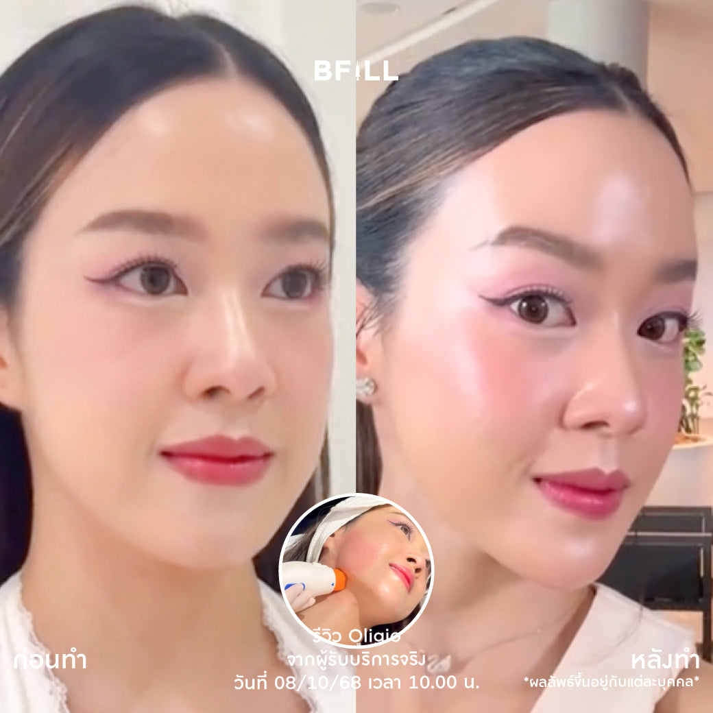 Oligio Free Thermage 韩国医生 最新紧致提升创新 正品 仅限Asok分店 Only Asok