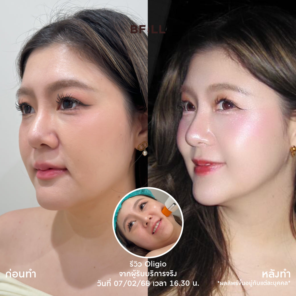 Oligio Free Thermage 韩国医生 最新紧致提升创新 正品 仅限Asok分店 Only Asok