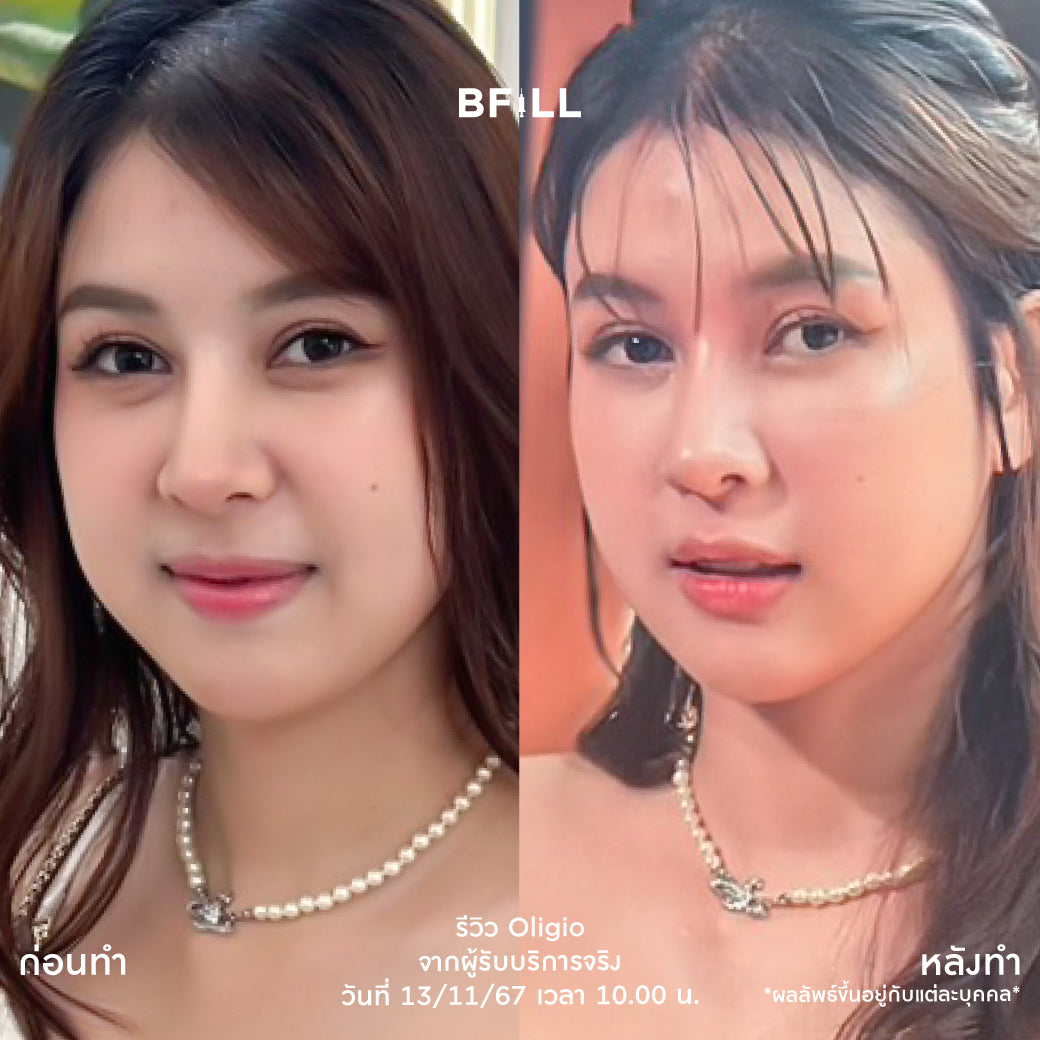 Oligio Free Thermage 韩国医生 最新紧致提升创新 正品 仅限Asok分店 Only Asok