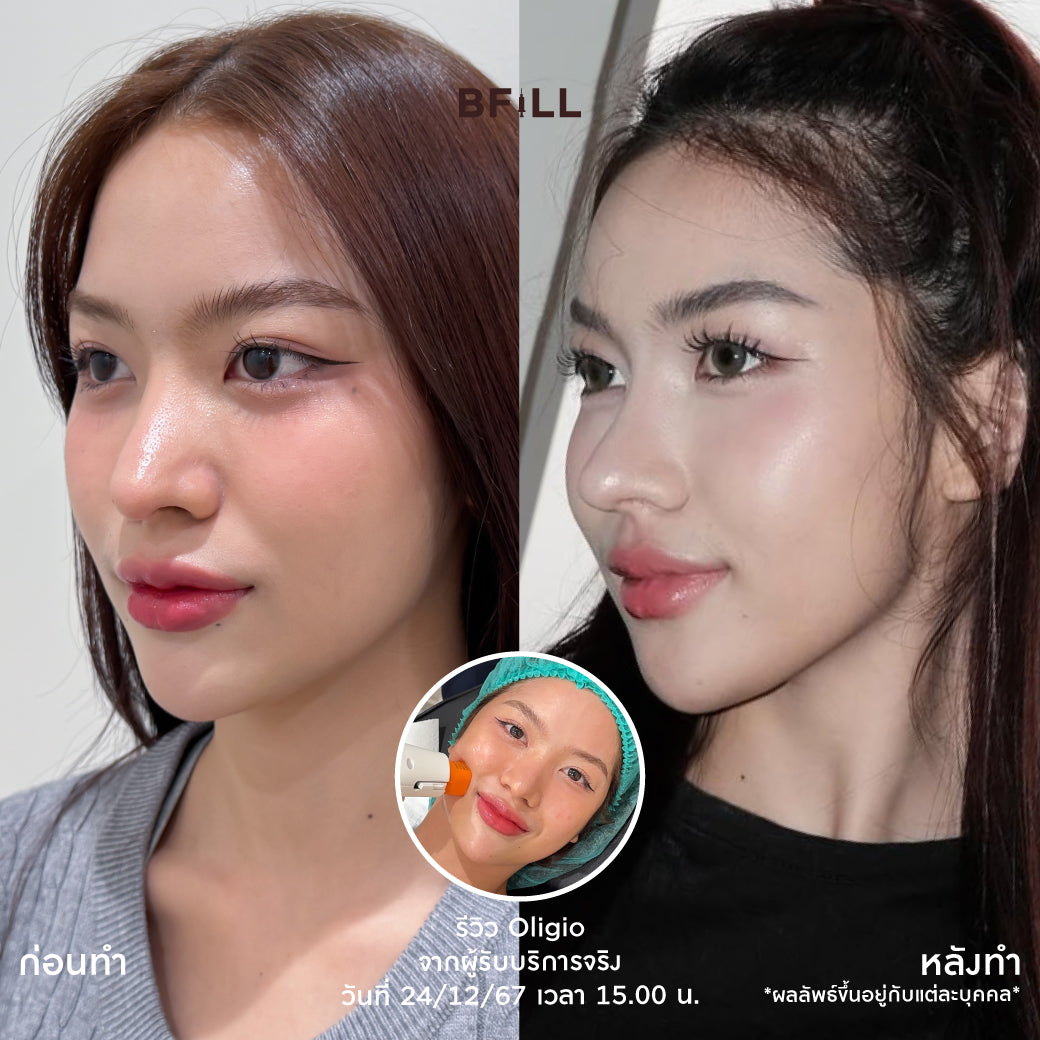 Oligio Free Thermage 韩国医生 最新紧致提升创新 正品 仅限Asok分店 Only Asok