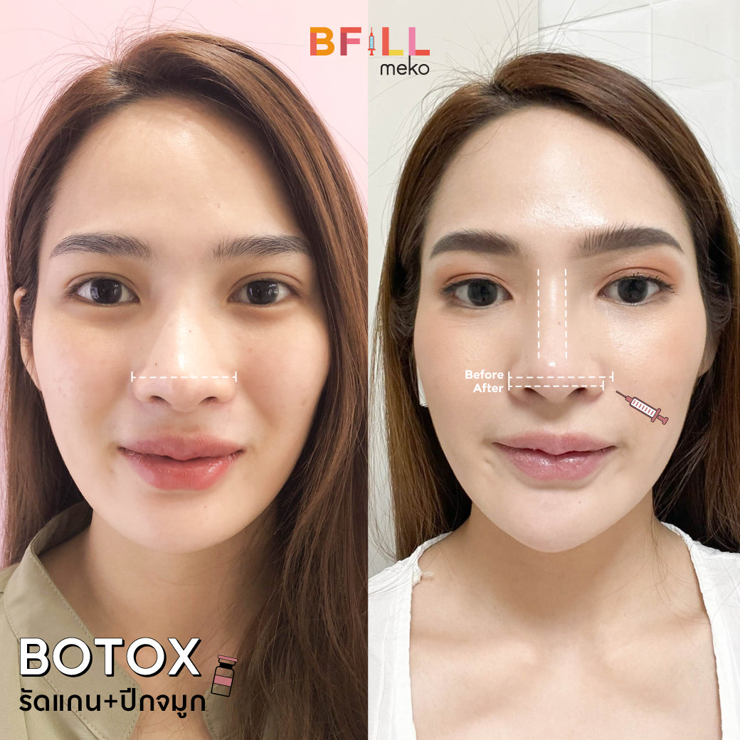 Botox Nabota โบท็อก Nabota