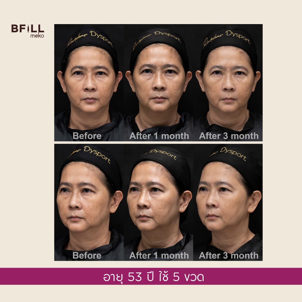 Sculptra collagen restoration innovation lasts up to 2 years