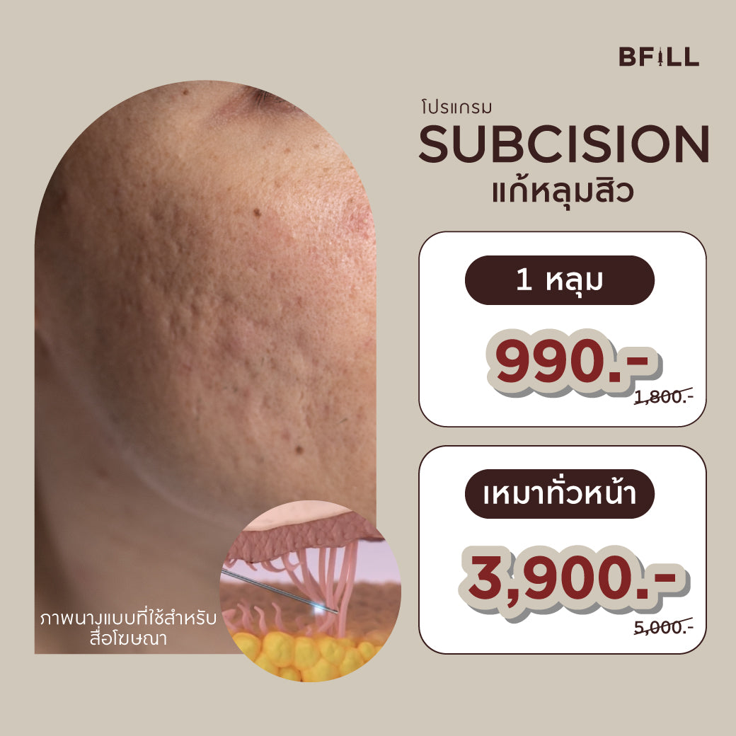 Program Subcision แก้หลุมสิว By Doctor