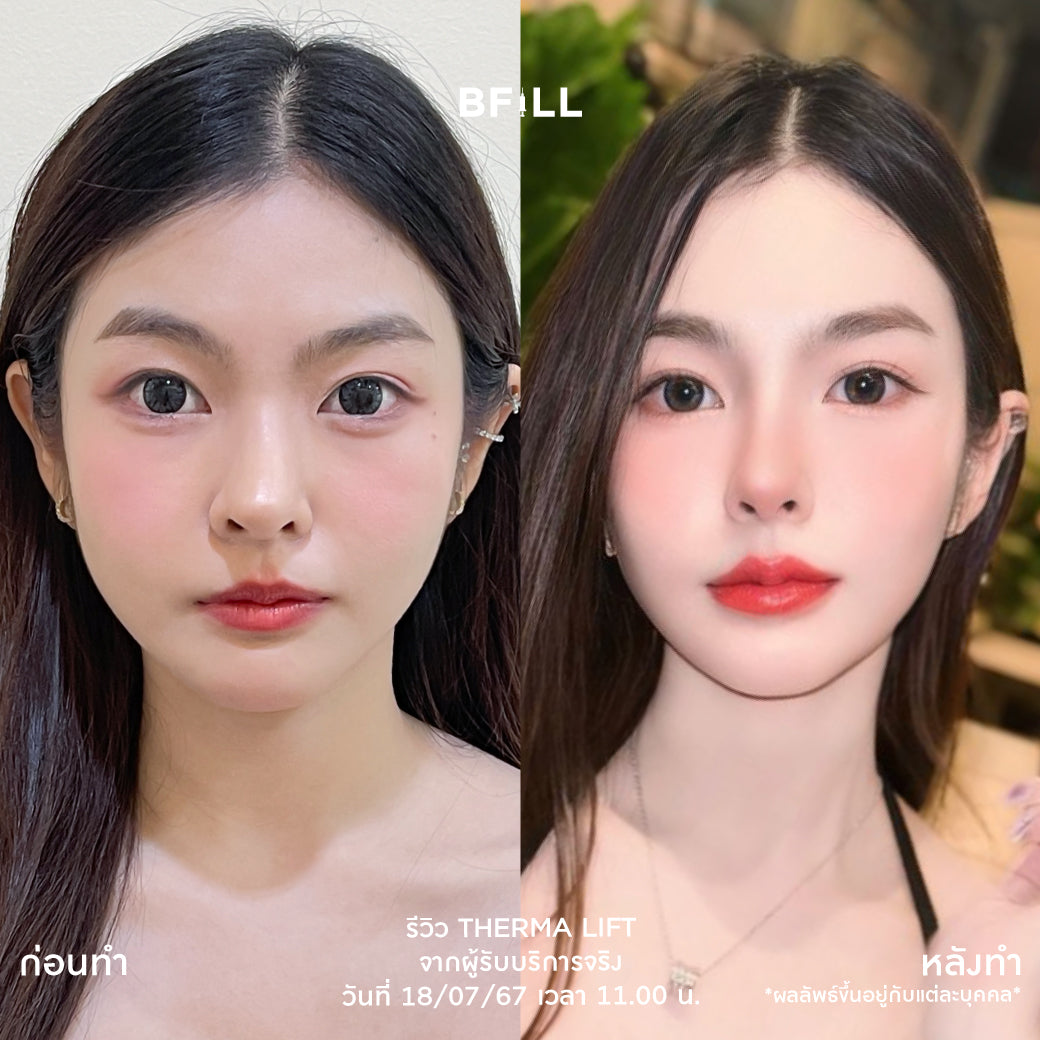 Thermage Korea By Specialist テルマージ韓国（専門家による施術）