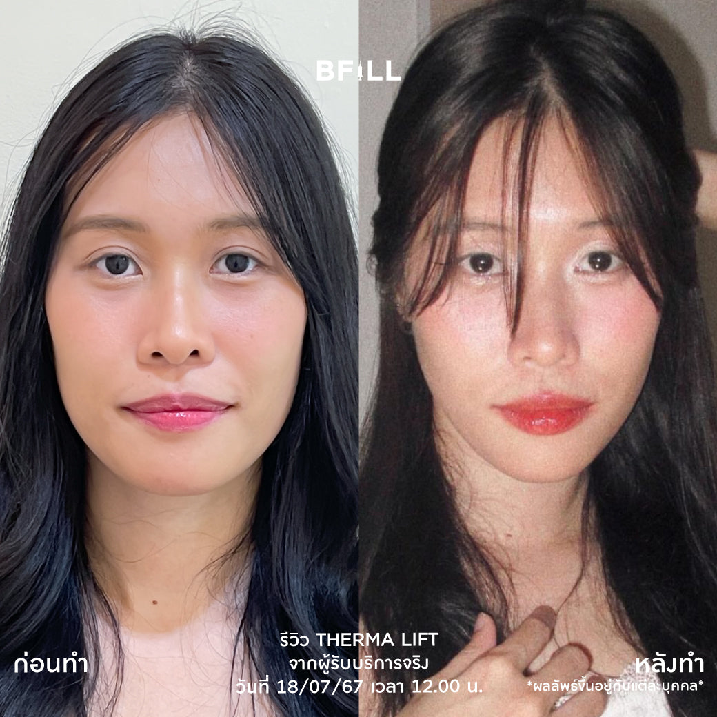 Thermage Korea By Specialist テルマージ韓国（専門家による施術）