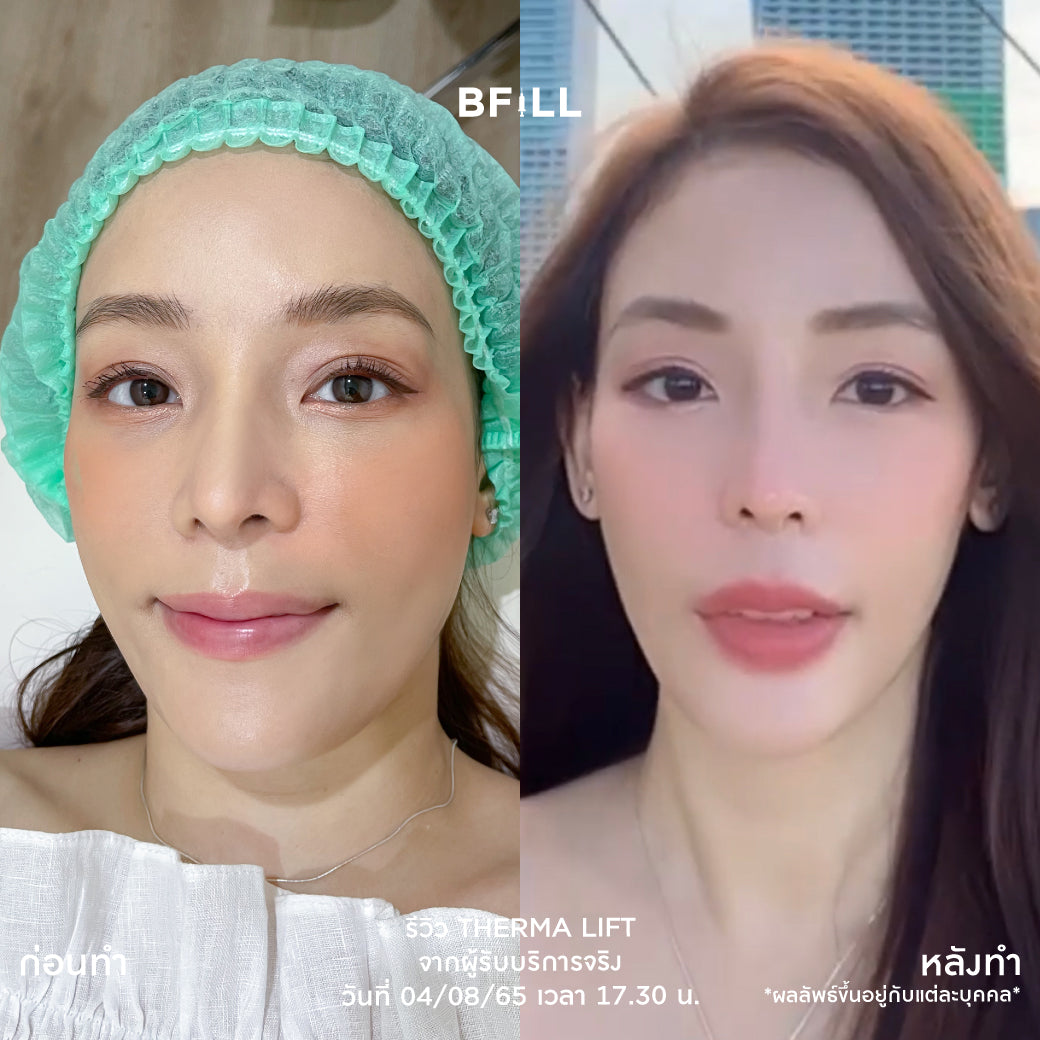 Thermage Korea By Specialist テルマージ韓国（専門家による施術）