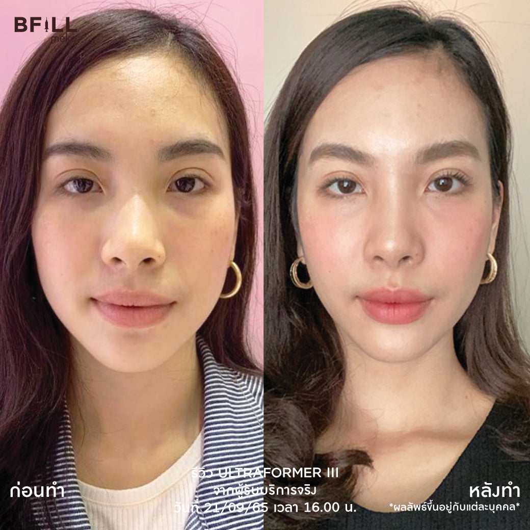 Ultra Former III 面部提升 by Doctor 不含麻醉（麻醉加200泰铢） 免费韩国热玛吉由专家提供