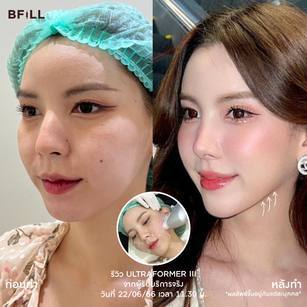 Ultra Former III 面部提升 by Doctor 不含麻醉（麻醉加200泰铢） 免费韩国热玛吉由专家提供