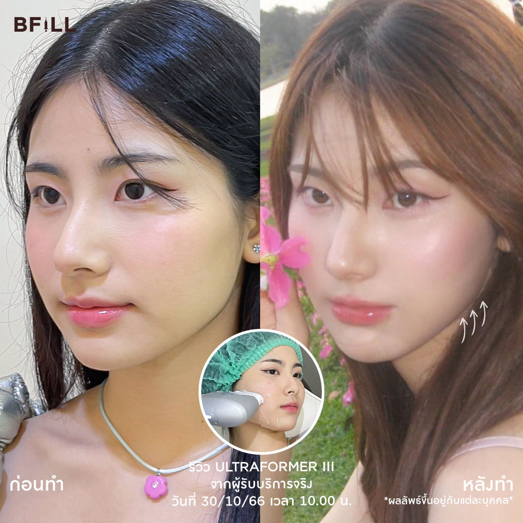 Ultra Former III 面部提升 by Doctor 不含麻醉（麻醉加200泰铢） 免费韩国热玛吉由专家提供