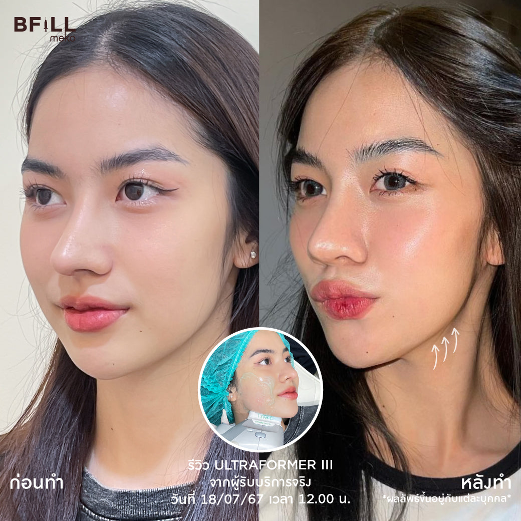 Ultra Former III 面部提升 by Doctor 不含麻醉（麻醉加200泰铢） 免费韩国热玛吉由专家提供